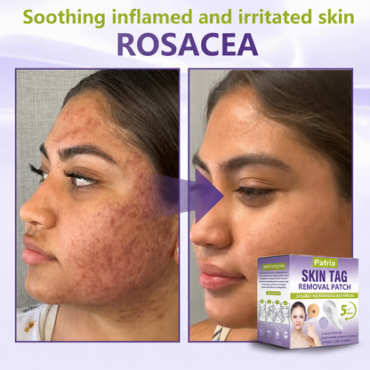 Pafrix® Soluble Microneedle Botanical Skin Tag Removal Patch