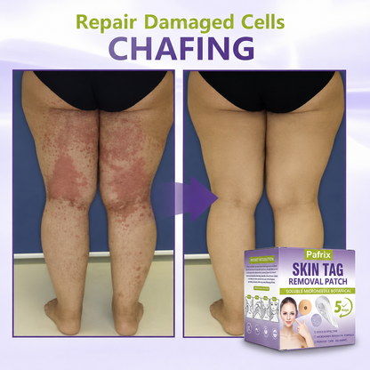 Pafrix® Soluble Microneedle Botanical Skin Tag Removal Patch