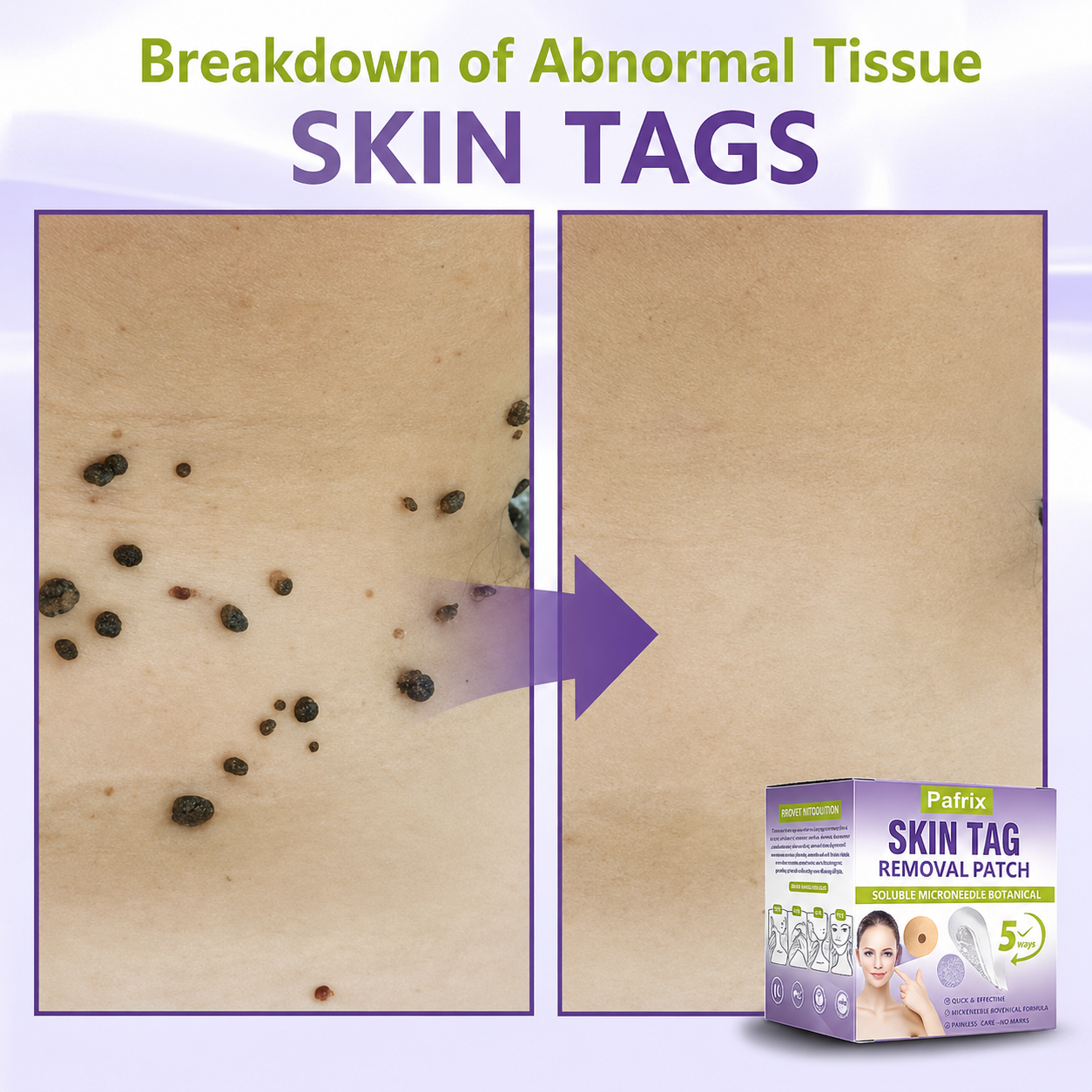 Pafrix® Soluble Microneedle Botanical Skin Tag Removal Patch