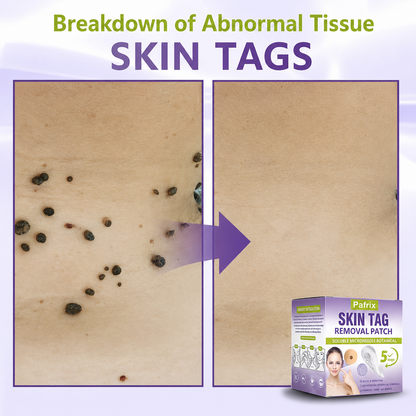 Pafrix® Soluble Microneedle Botanical Skin Tag Removal Patch