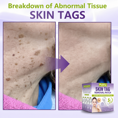 Pafrix® Soluble Microneedle Botanical Skin Tag Removal Patch
