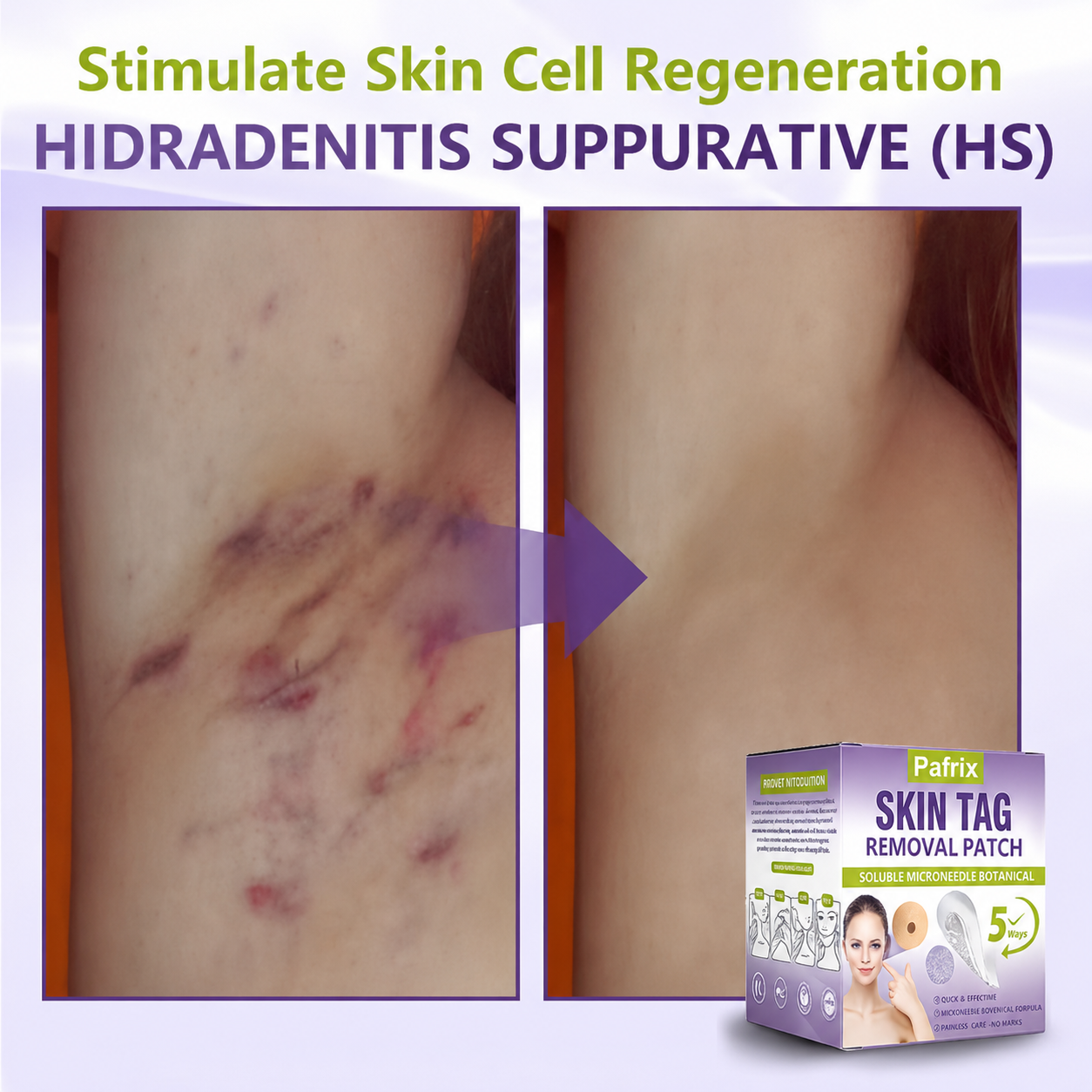 Pafrix® Soluble Microneedle Botanical Skin Tag Removal Patch