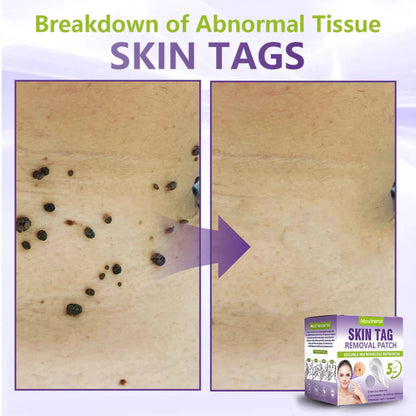 Pafrix® Soluble Microneedle Botanical Skin Tag Removal Patch