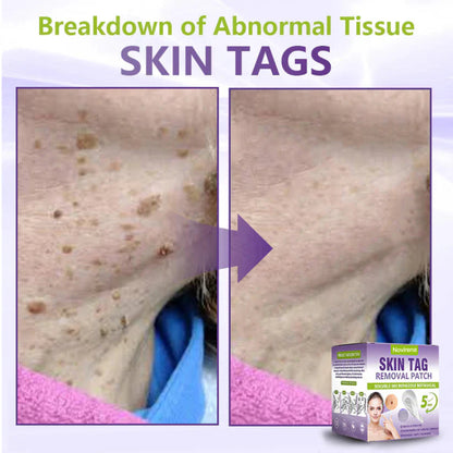 Pafrix® Soluble Microneedle Botanical Skin Tag Removal Patch