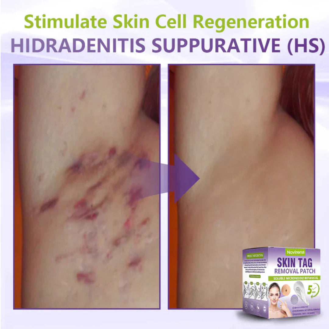 Pafrix® Soluble Microneedle Botanical Skin Tag Removal Patch