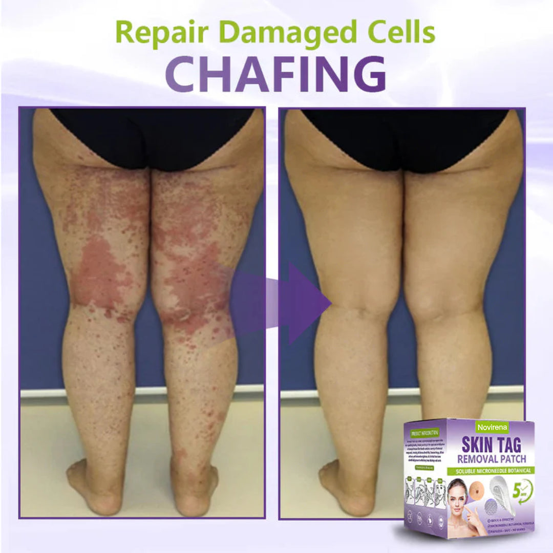 Pafrix® Soluble Microneedle Botanical Skin Tag Removal Patch