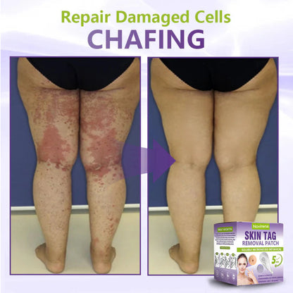 Pafrix® Soluble Microneedle Botanical Skin Tag Removal Patch