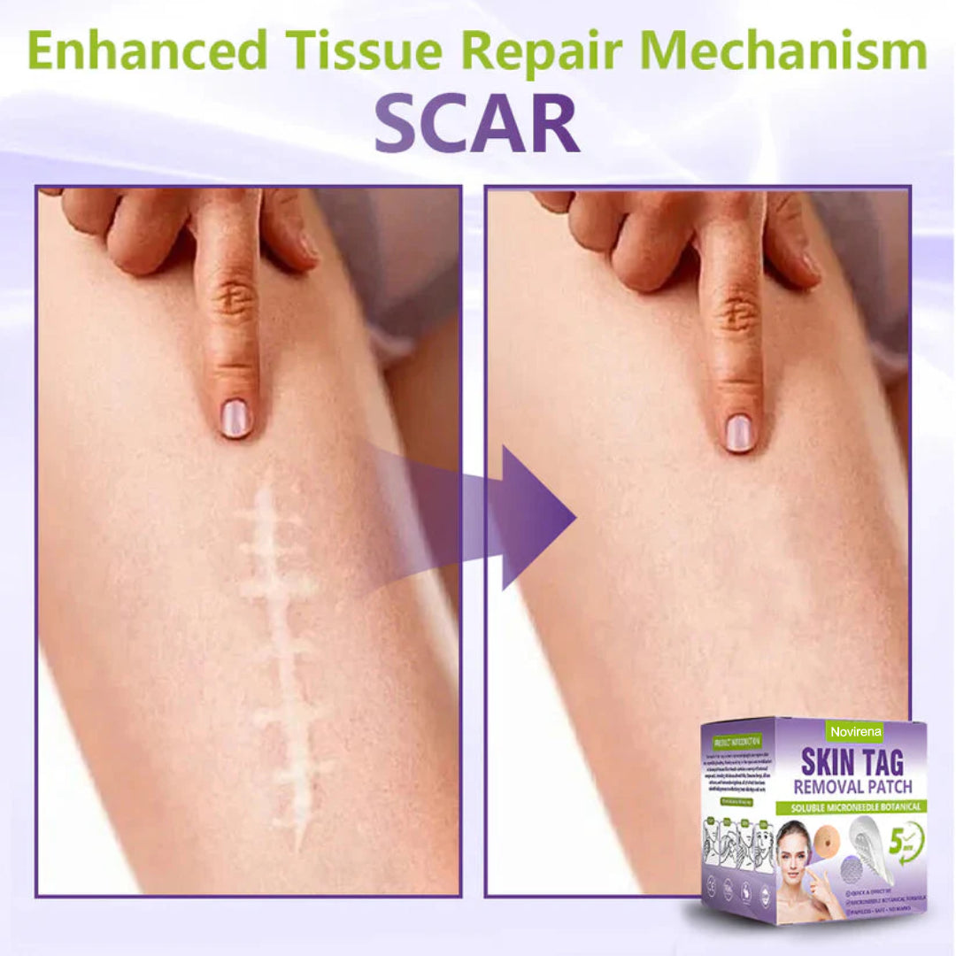 Pafrix® Soluble Microneedle Botanical Skin Tag Removal Patch