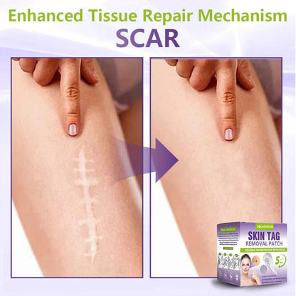 Pafrix® Soluble Microneedle Botanical Skin Tag Removal Patch