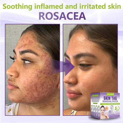 Pafrix® Soluble Microneedle Botanical Skin Tag Removal Patch