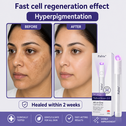 🔥 NEW 2026 GEN 2 Update☂Pafrix® VelvetSkin+ Photorejuvenation2.0 ⚔️All-in-One Laser Eraser Pen🖊️ (🔬Powered by Photorejuvenation – effectively removes moles, warts, skin tags, pigmentation spots, and other skin imperfections)