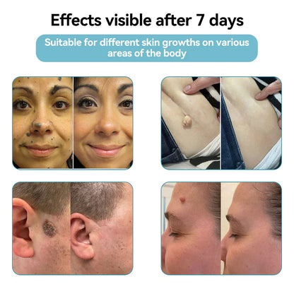 🔥 NEW 2026 GEN 2 Update☂Pafrix® VelvetSkin+ Photorejuvenation2.0 ⚔️All-in-One Laser Eraser Pen🖊️ (🔬Powered by Photorejuvenation – effectively removes moles, warts, skin tags, pigmentation spots, and other skin imperfections)