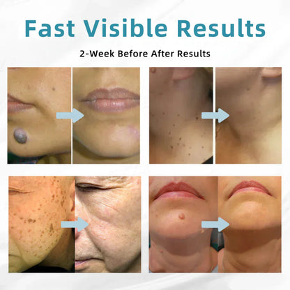 🔥 NEW 2026 GEN 2 Update☂Pafrix® VelvetSkin+ Photorejuvenation2.0 ⚔️All-in-One Laser Eraser Pen🖊️ (🔬Powered by Photorejuvenation – effectively removes moles, warts, skin tags, pigmentation spots, and other skin imperfections)