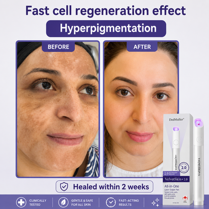 🔥 NEW 2026 GEN 2 Update☂Pafrix® VelvetSkin+ Photorejuvenation2.0 ⚔️All-in-One Laser Eraser Pen🖊️ (🔬Powered by Photorejuvenation – effectively removes moles, warts, skin tags, pigmentation spots, and other skin imperfections)