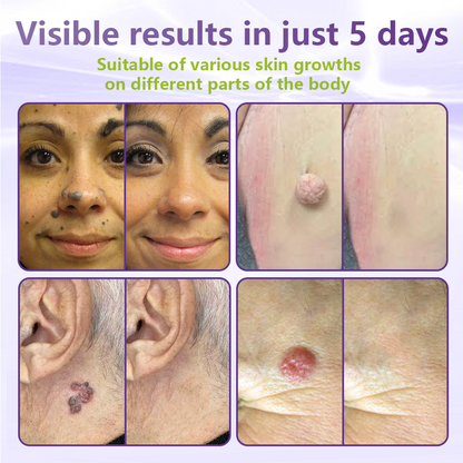 Pafrix® Soluble Microneedle Botanical Skin Tag Removal Patch