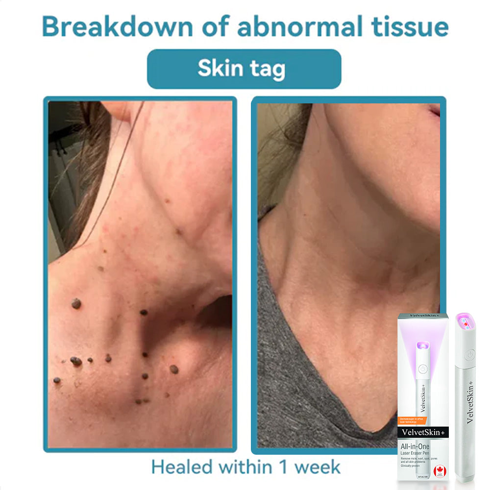 🔥 NEW 2026 GEN 2 Update☂Pafrix® VelvetSkin+ Photorejuvenation2.0 ⚔️All-in-One Laser Eraser Pen🖊️ (🔬Powered by Photorejuvenation – effectively removes moles, warts, skin tags, pigmentation spots, and other skin imperfections)