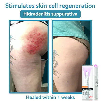 🔥 NEW 2026 GEN 2 Update☂Pafrix® VelvetSkin+ Photorejuvenation2.0 ⚔️All-in-One Laser Eraser Pen🖊️ (🔬Powered by Photorejuvenation – effectively removes moles, warts, skin tags, pigmentation spots, and other skin imperfections)